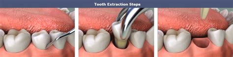 Tooth Extraction Glendale Smile Makeover Of La