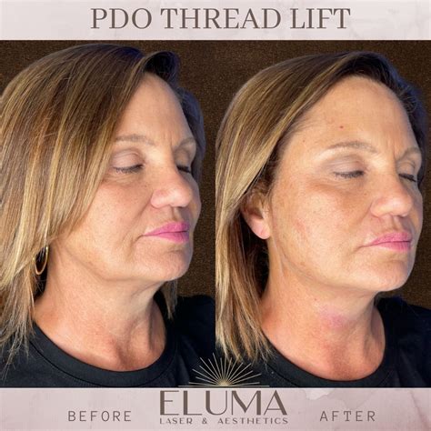 Pdo Thread Lift Eluma Laser Aesthetics