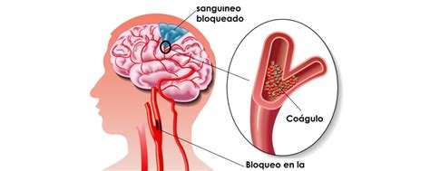 Accidente Cerebrovascular Isquémico