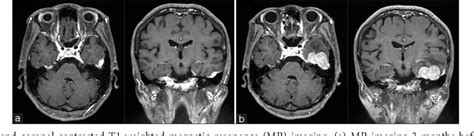 Figure 1 From Intracranial Plasmacytoma Arising From Dura Mater