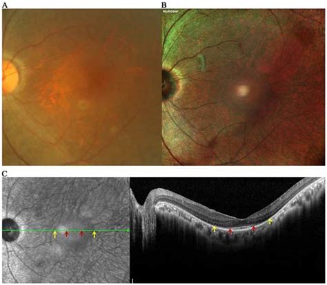 Comparison Of Fundus Photography And Multicolor Imaging In The