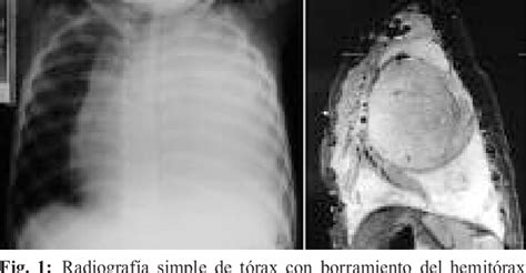 Figure 1 from Blastoma pleuropulmonar un tumor pediátrico infrecuente