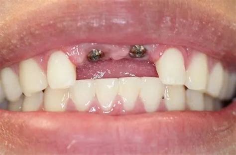 Metallic Non Surgical Dental Implant Surgery Service For Replacement