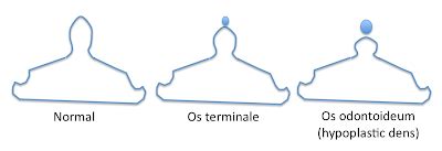 RiT radiology: Os Terminale - Os Odontoideum Complex (1)