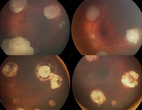 Retinoblastoma Management Update Part 2 Treatment Screening And