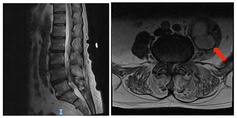 MRI Of Lumbo Sacral Spine Showing Left Facet Joint Septic Arthritis