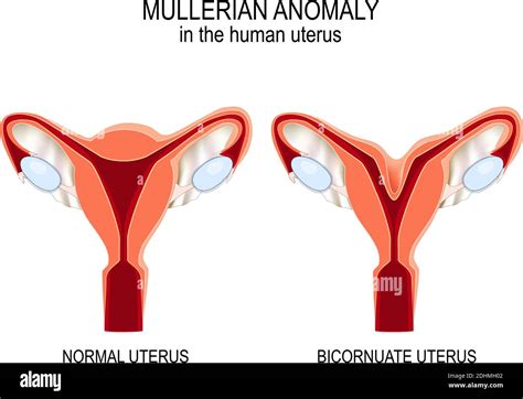 Mullerian Anomaly In The Human Uterus Normal Womb And Bicornuate