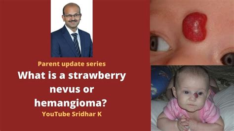 What Is A Strawberry Hemangioma When Does It Need Treatment How To