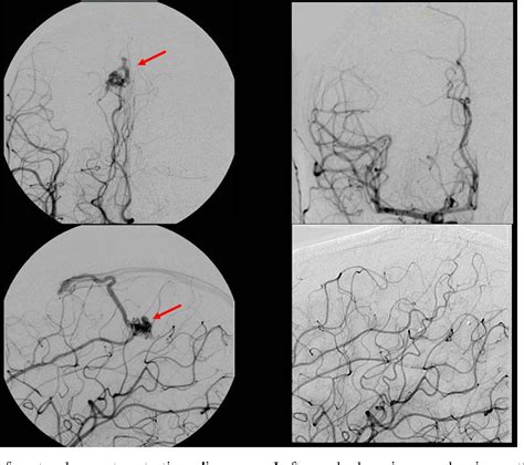 Figure 2 From Clinical Investigation Central Nervous System Tumor Single Fraction Proton Beam