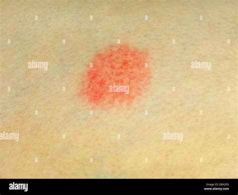 Red Spots On Skin Causes