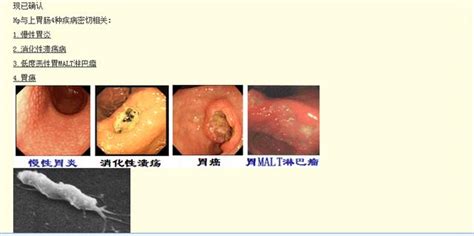 幽門螺桿菌（hp）感染研究進展，表明和多種疾病有關，應高度重視 每日頭條