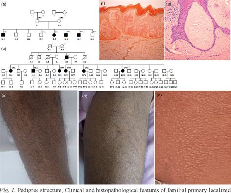 Figure 1 From Familial Primary Localized Cutaneous Amyloidosis Results