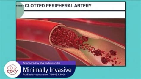 Greg Martin Md What Is Peripheral Arterial Disease Interventional