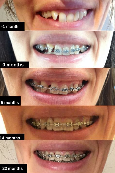 Braces At 30 14th Tightening 22 Months Before And After Photos In