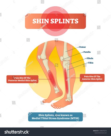 15 Medial Tibial Stress Syndrom Images Stock Photos Vectors