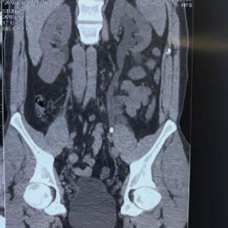 Coronal Reconstruction Of Ct Scan Showing A Midureteral Calculus