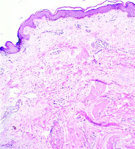 Histopathology H And E Showing Dermal Edema Fenestrations And