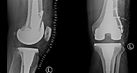 Revision Knee Replacement Orthopaedics Wa