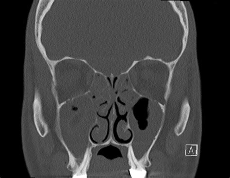 Fess Paranasal Sinus Surgery Ent Vienna Dr Wimmer