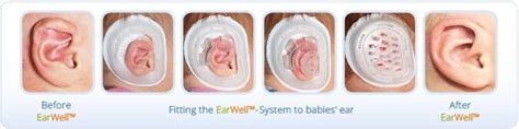 Newborn Ear Correction | Baby Ear Reshaping Atlanta, GA