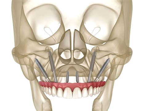 Zygomatic Implants Zygomatic Implant San Leandro CA San Francisco