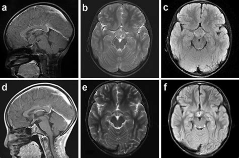 Cerebral Mri Performed Preoperatively Revealed A Lesion Measuring