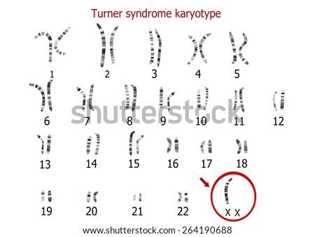 Turner Syndrome Karyotype Stock Illustration 264190688 Shutterstock