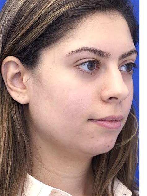 Cases In Rhinoplasty Chin Implant Mao Facial Plastics