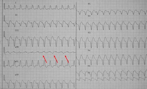 File:Wide qrs tachy AAM4.png - ECGpedia