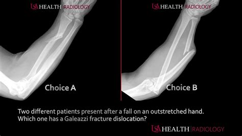 Galeazzi Versus Monteggia Fracture Dislocations Youtube