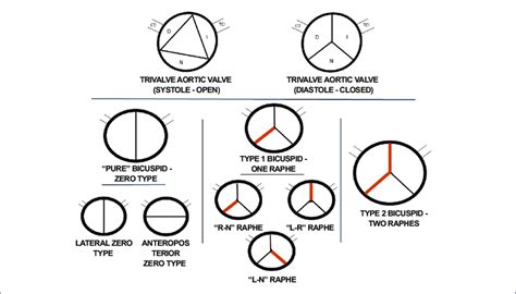 Diagram Of Bicuspid Valve Types Classification According To Sievers And