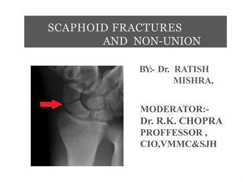 Scaphoid Nonunion Advanced Collapse 6