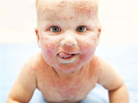 Atopik Dermatit Nedenleri – Minidolin Bebek Şampuan ve Nemlendiricisi