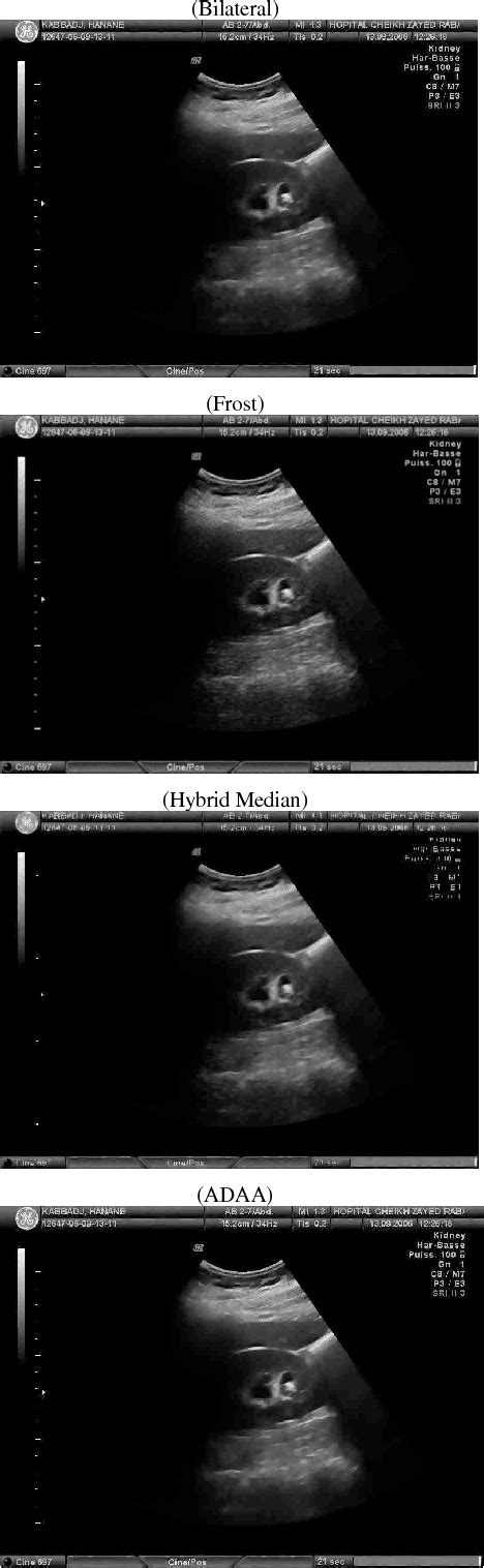 Figure 2 From Ultrasound Image Enhancement Using An Adaptive