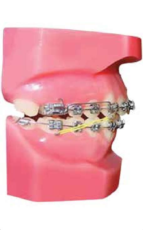 T10 Second Stage Use Of Class Ii Elastics Anchored On The Lower First Download Scientific