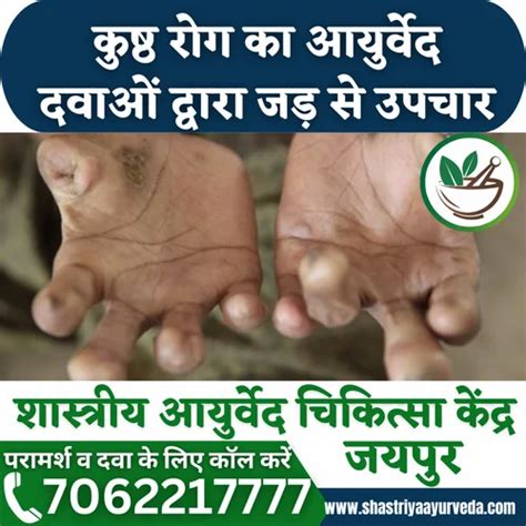 Leprosy Treatment Service at ₹ 1000/session in Jaipur | ID: 2852149068197