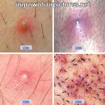 European Hornet Sting Treatment Ingrown Hair On Balls Treatment