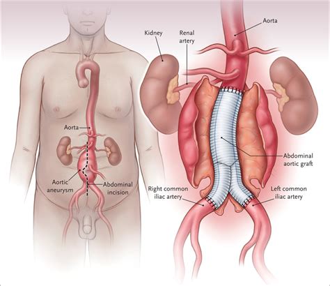 Abdominal Aorta Crosses Diaphragm At