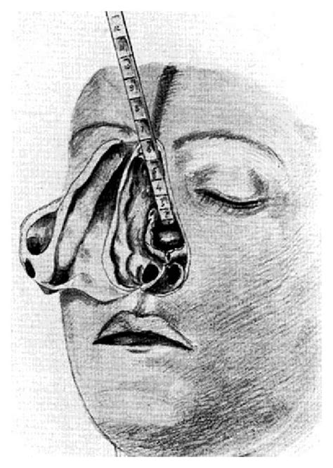 Superior Transsphenoidal Approach As Used In The First Transsphenoidal