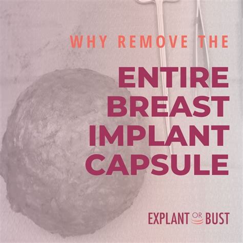 Removing The Entire Breast Implant Capsule Explant Or Bust