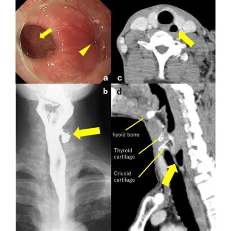 Preoperative Findings A Esophagogastroduodenoscopy Showed A