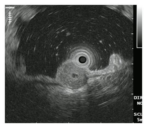 Endoscopic Submucosal Dissection Of A Gastric Gist A A Subepithelial