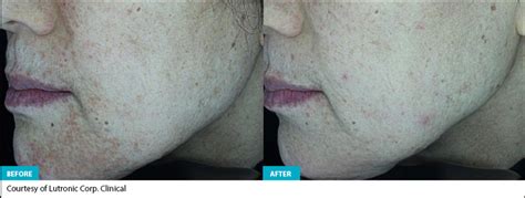 Lutronic Dermav™ Fresno Ca Behr Laser And Skin Care Center