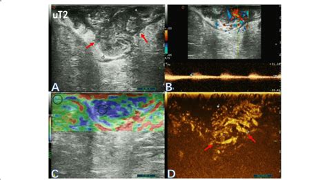 Two Dimensional Ultrasonogram A Color Flow And Pulsed Doppler Image