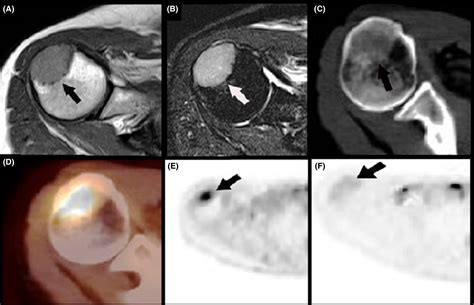 Promyelocytic Sarcoma Of The Right Humerus An Unusual Clinical