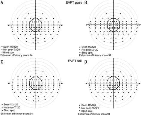 Binocular Esterman Visual Field Test Results A B Patients Pass