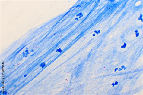 Mycobacterium Tuberculosis Positive Small Red Rod In Sputum Smear Acid Fast Stain Analyze By