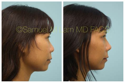 This Asian Patient Is Shown Before And After Augmentation Rhinoplasty Using A Combination Of