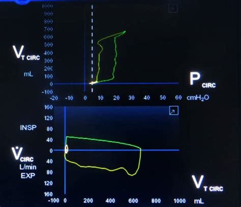 Ventilator Waveforms