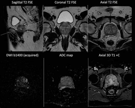 Medizzy Prostate Mr Imaging In A Patient With Elevated Psa